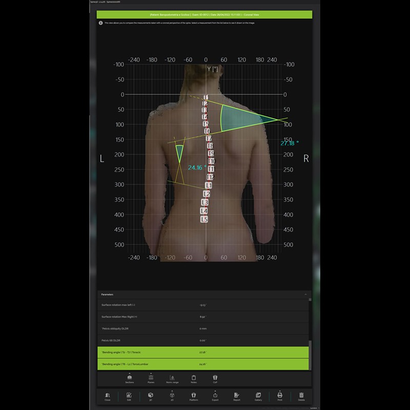 Система трёхмерного сканирования позвоночника Spine3D